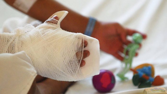 mano quemada, fuego, niños